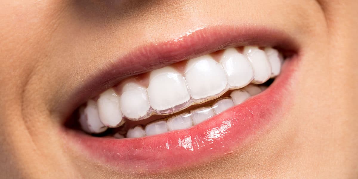 Invisalign