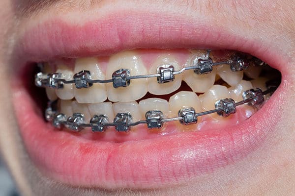 Braces to correct cross bite