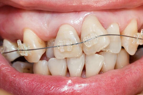 Teeth are overly crowded and incorrectly aligned