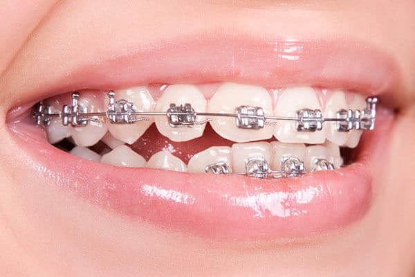 Braces to correct open bite