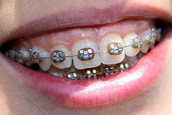 Braces to correct overbite