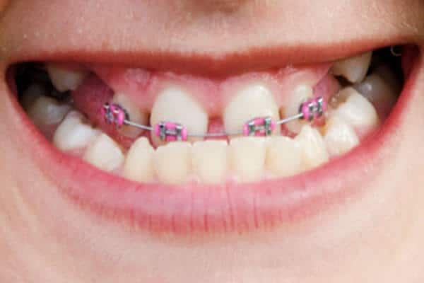 braces to correct underbite